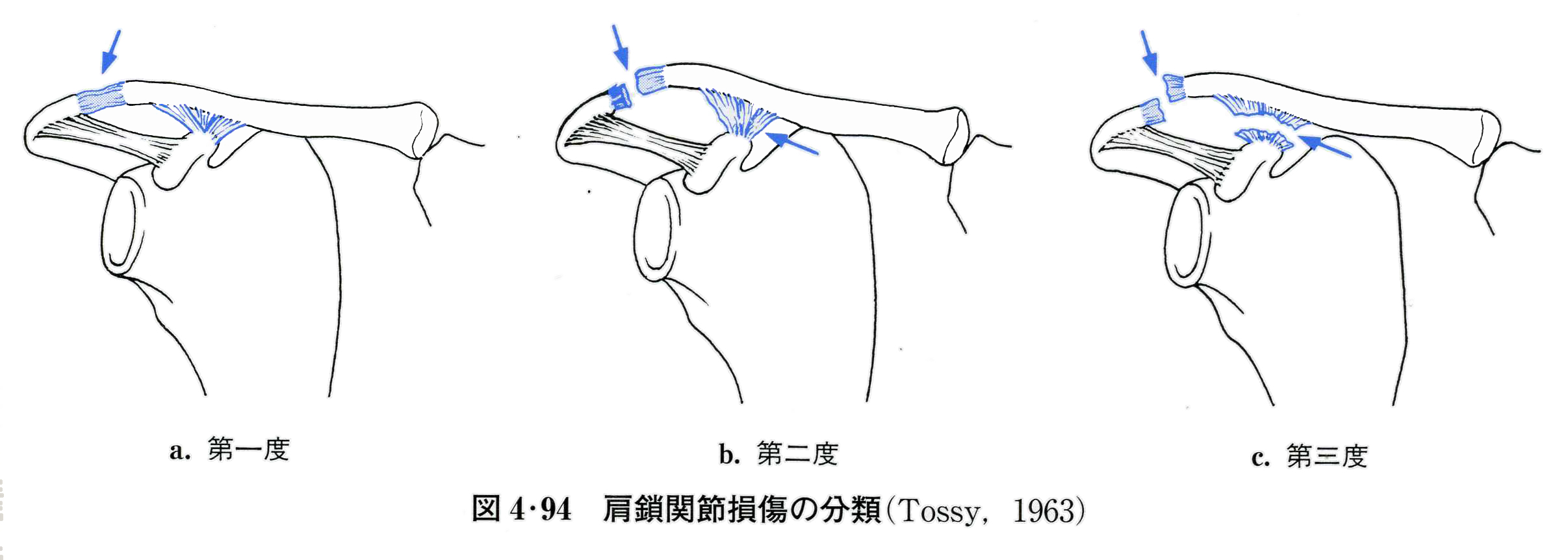 肩鎖関節脱臼