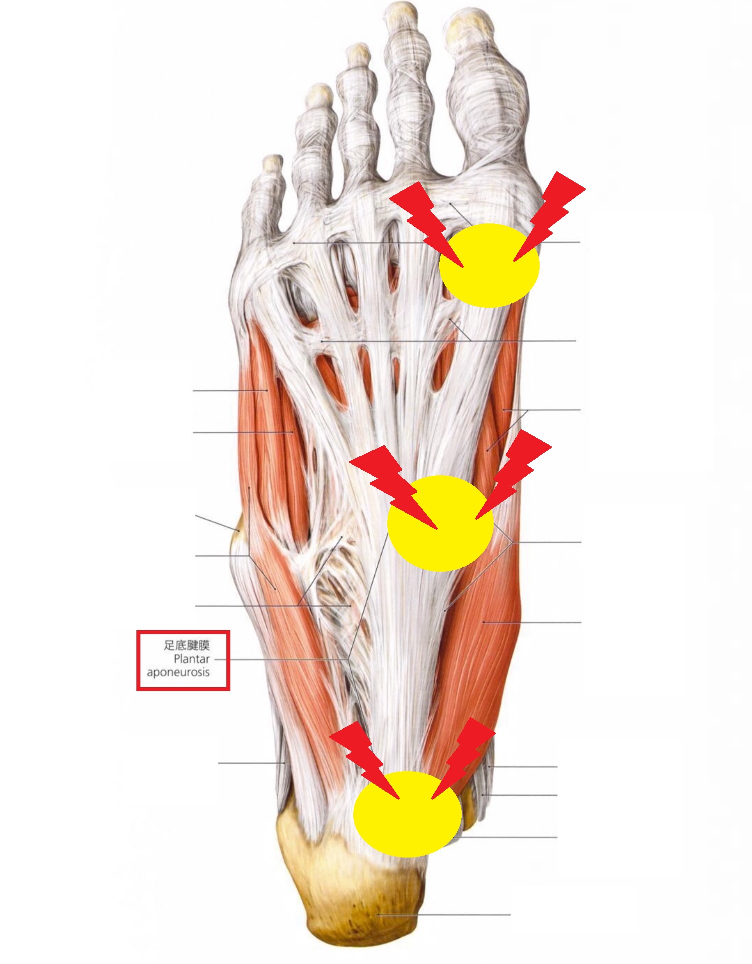 足底筋膜