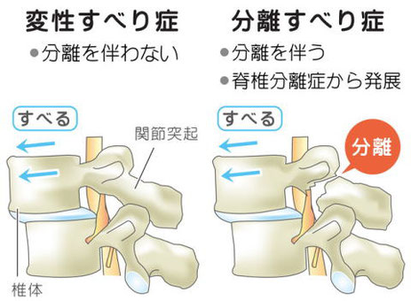 腰椎分離すべり症