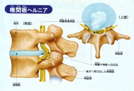 椎間板ヘルニア資料