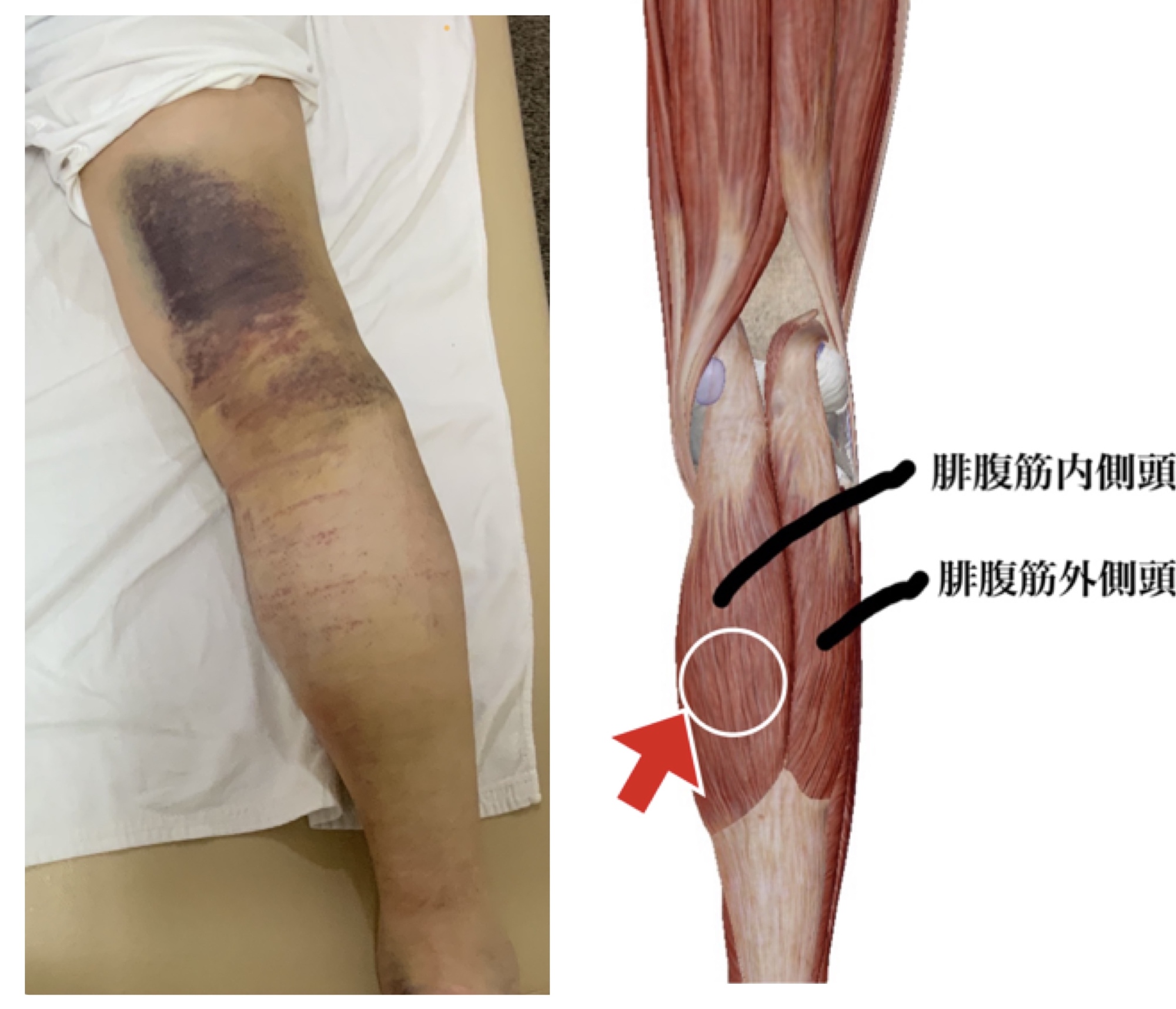 肉離れが起こった箇所に視覚から見える写真